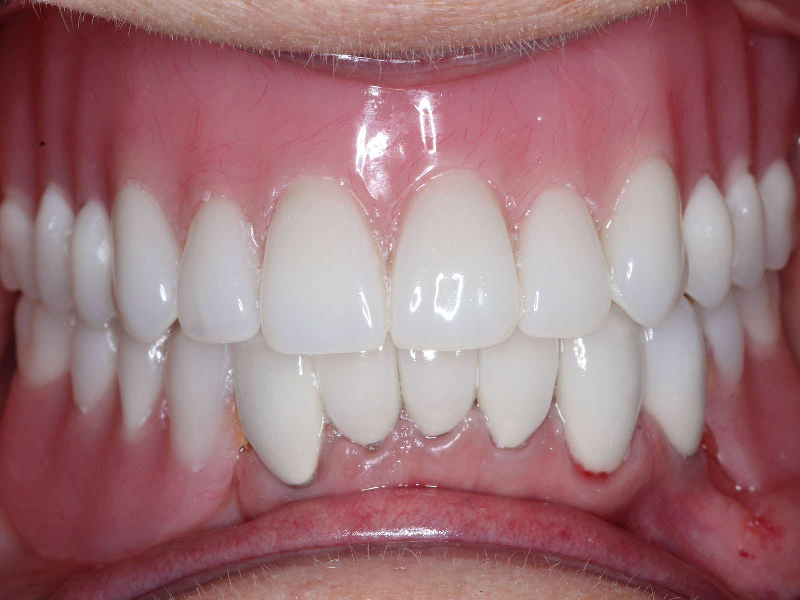 professional teeth whitening