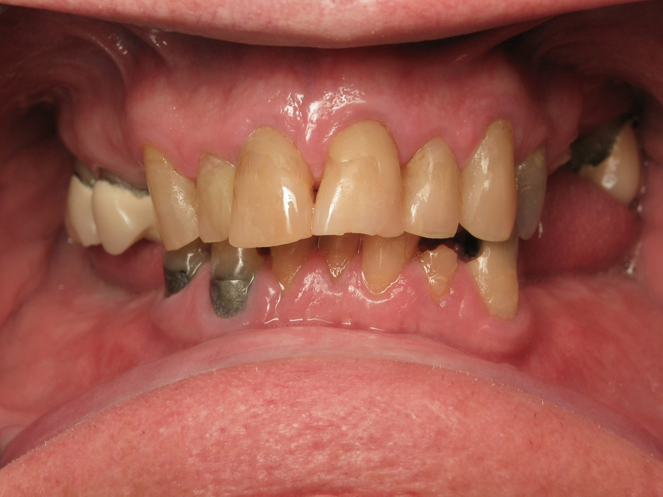 5-1-before-full-arch-upper-ceramic-crowns-lower-hybrid